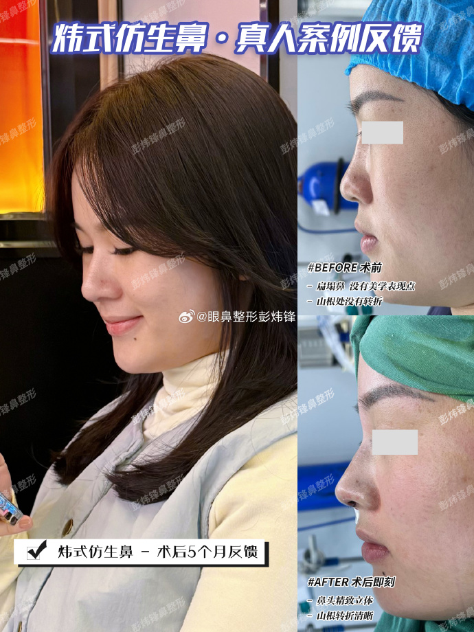 长沙彭炜锋鼻子做的怎么样？