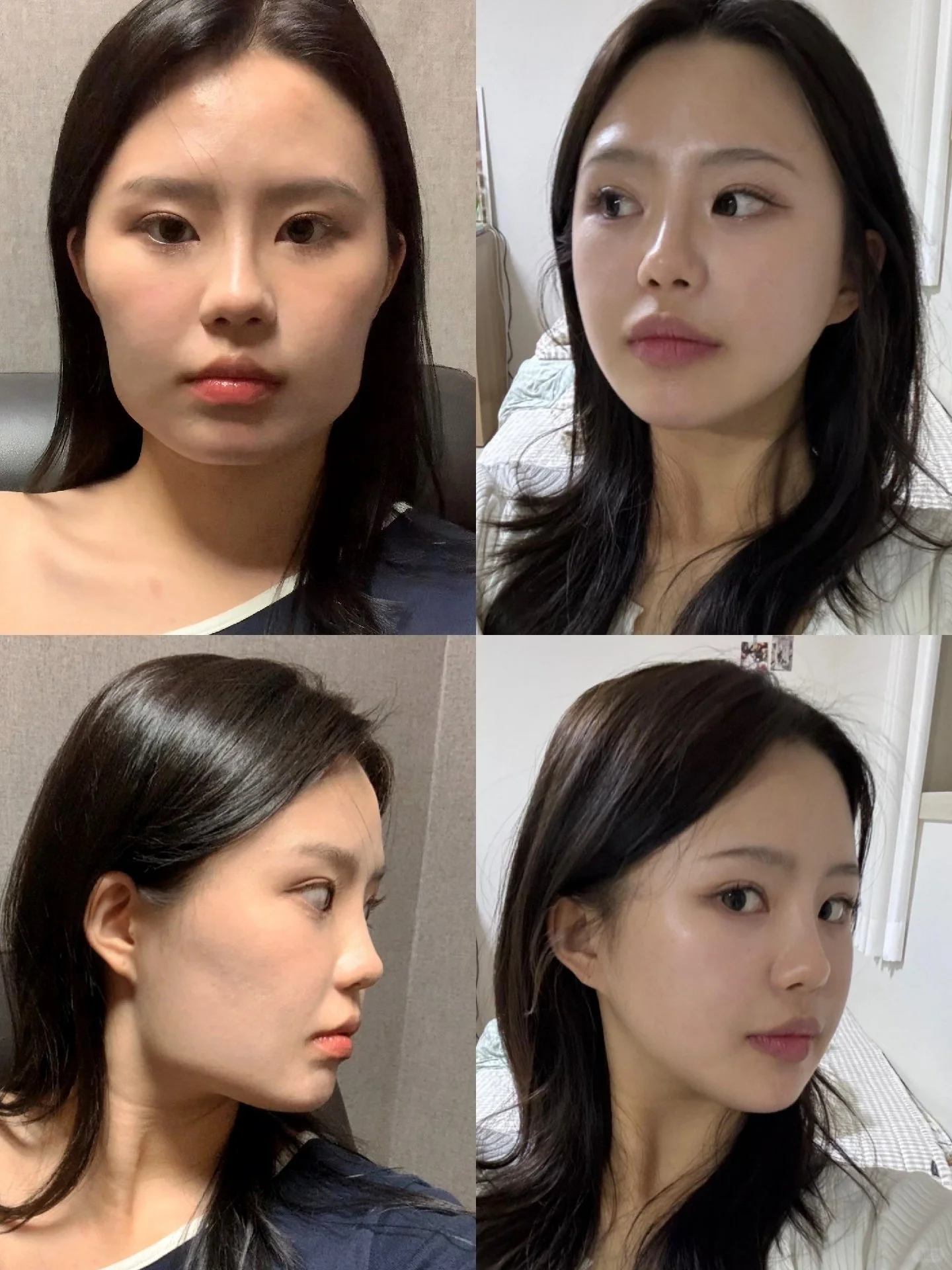 重庆朱乐林和肖林哪个医生做磨骨好？
