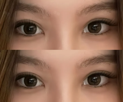 南宁李艳和蒙旭昌哪个医生做双眼皮好？
