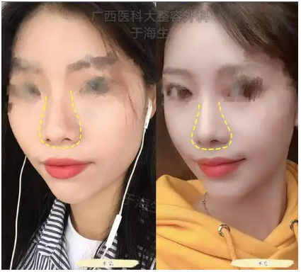 南宁隆鼻于海生和刘泳铖哪个医生技术好？