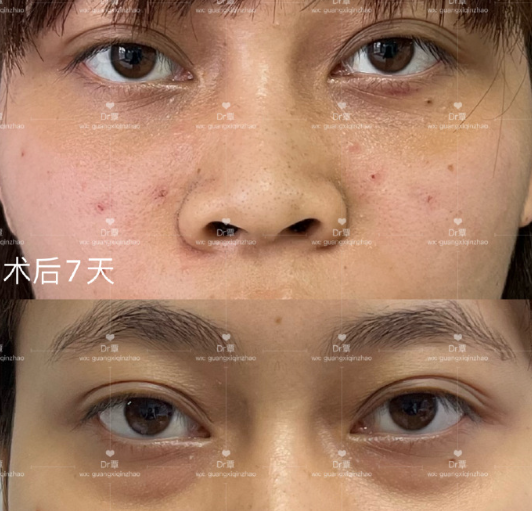 南宁覃朝和蒙旭昌哪个医生去眼袋比较好？