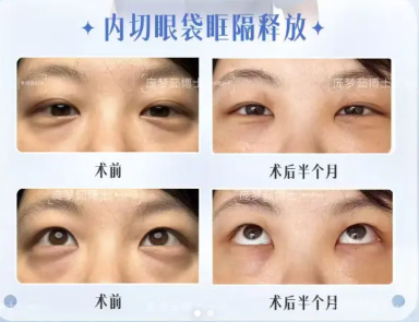 贵阳庞梦茹和安宁哪个祛眼袋技术好？