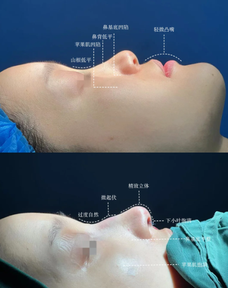 北京八大处张旭龙做隆鼻怎么样？