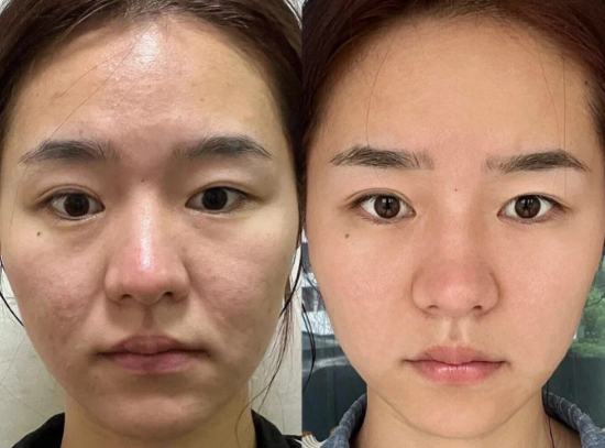 北京王春虎和谢洋春哪个医生做拉皮好？