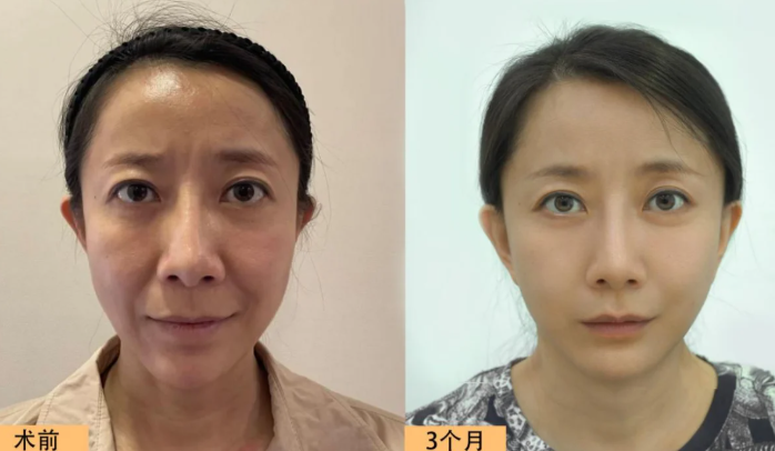 北京拉皮手术哪个医生做得最好？赵延勇、杜太超、王春虎、袁强