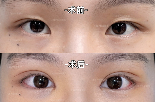 上海卢玲和杨海平哪个修复双眼皮好？