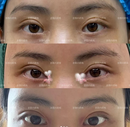 上海曾翾和马娟医生哪个做眼修复技术好？