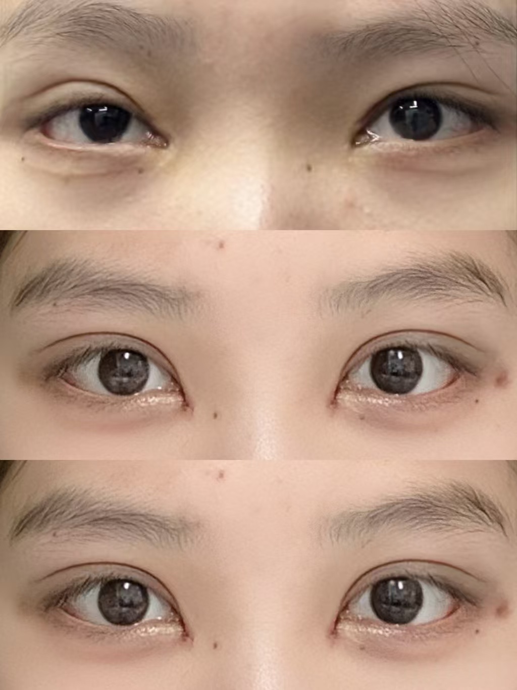 上海双眼皮修复哪个医生最好？佀同帅、刘平、卢玲、马娟、郑小红