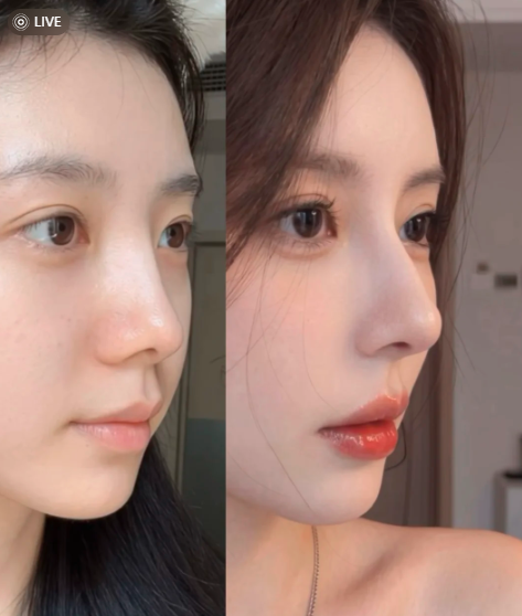 广州隆鼻哪个医生好？潘卫峰和李希军哪个技术好？
