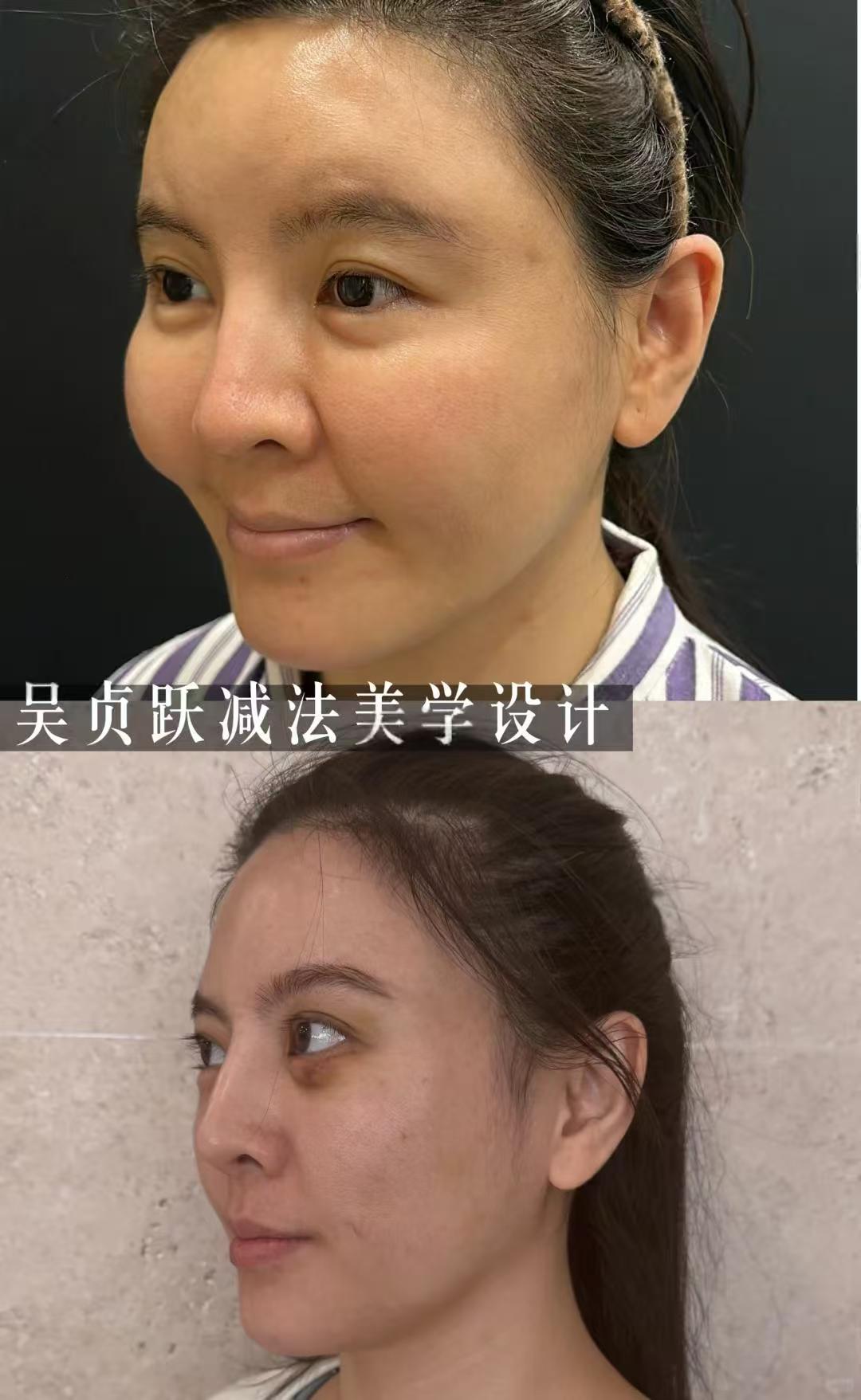 2026年上海馒化修复吴贞跃和张本军哪个医生技术好？