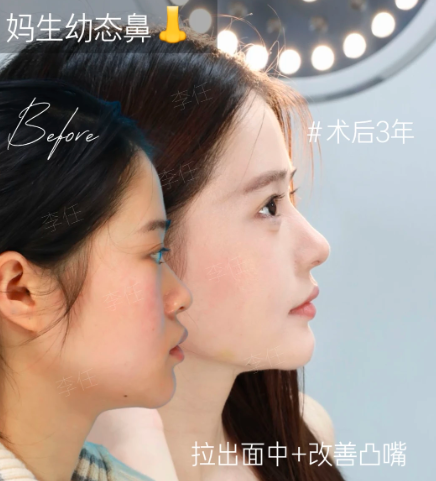 2026年西安做鼻子比较好的医生有哪些？曾熬和霍玉旺哪个更好？