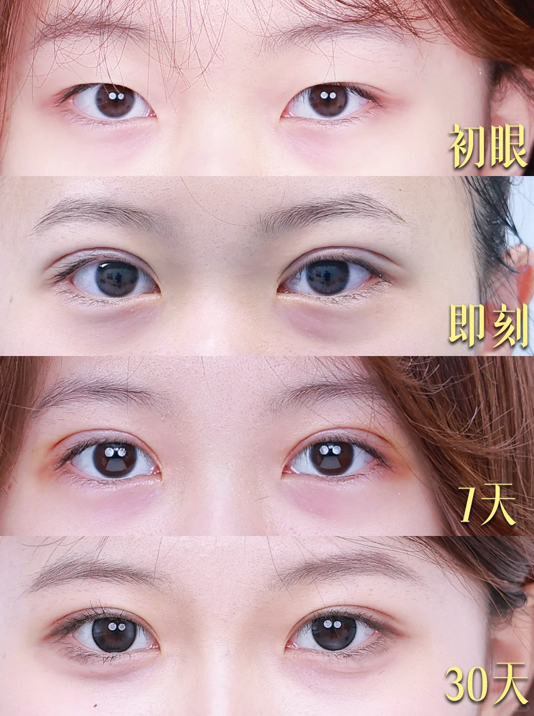 天津知名的双眼皮医生都有谁？何祥龙和卜胜利哪个医生技术比较稳？