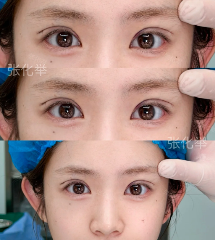 上海双眼皮医生哪个技术口碑好？卢玲和马娟哪个性价比高？