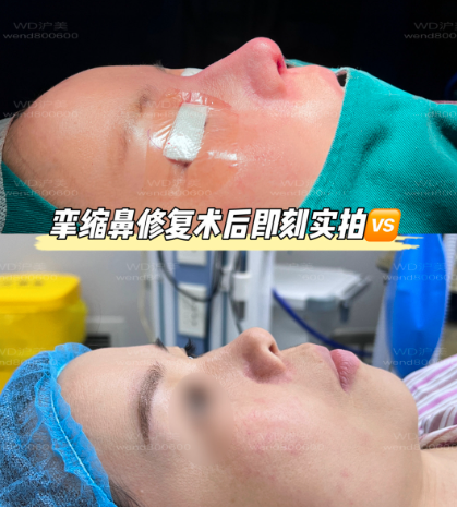 上海李章医生做鼻子怎么样？口碑和技术怎么样？收费怎么样？