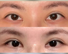 上海九院顾钏做双眼皮修复怎么样？技术怎么样？
