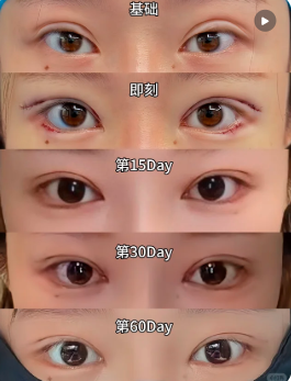 上海武战强修复双眼皮技术怎么样？口碑好不好？