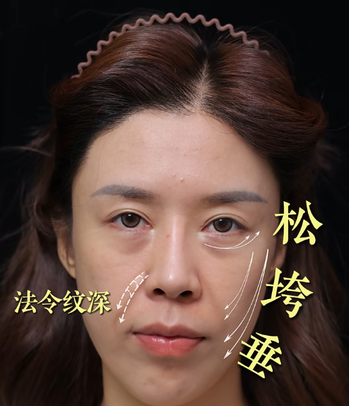 北京陈凤超医生做面部提升技术怎么样？效果好不好？收费贵不贵？