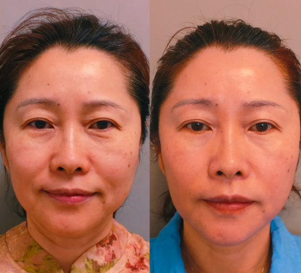 西安李超做拉皮技术靠谱吗？技术怎么样？大概收费多少？