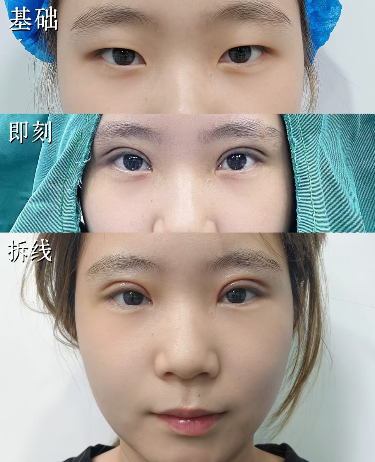 惠州王存富做双眼皮怎么样？大概多少钱？