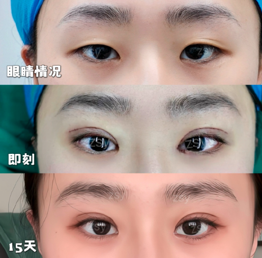 北京割双眼皮哪个医生好？张双溢和姬东硕哪个更好？