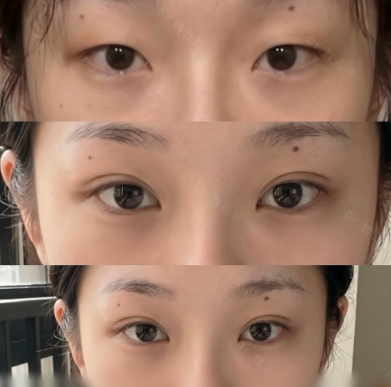 上海魏云玲和杨洪波割双眼皮哪个好？