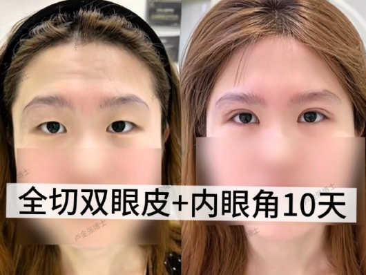 广州卢金强医生做双眼皮口碑怎么样？