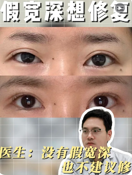 求上海九院双眼皮修复推荐！顾钏和杨军哪个医生好？