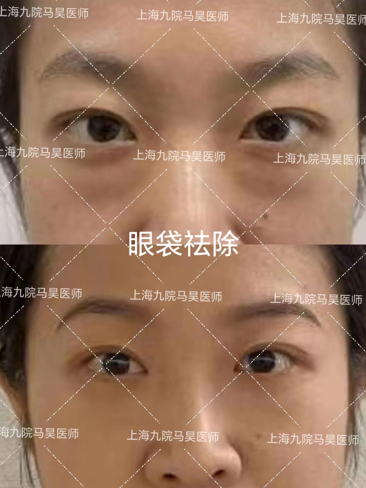​​上海九院马昊做眼袋手术怎么样？马昊祛眼袋术后效果好不好？