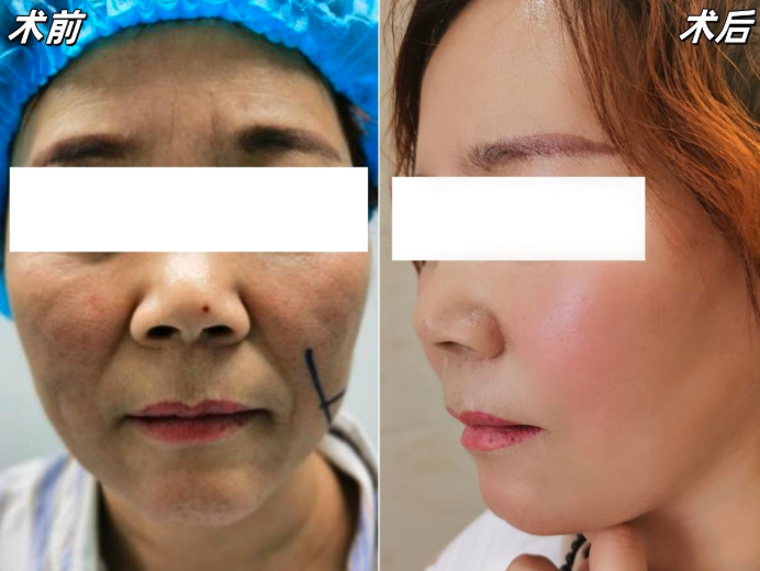 郑州面部年轻化医生温志华怎么样？温志华面部提升技术口碑好不好？