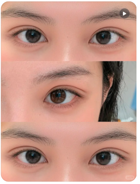 哈尔滨双眼皮医生推荐哪个？滕双艳、李宁、宋明亮、吴谦双眼皮技术谁最好？