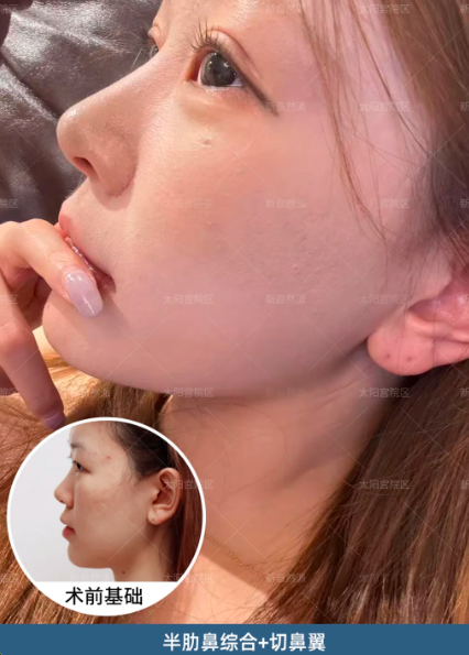 北京王彦驰做鼻综合技术怎么样?王彦驰鼻综合返修率高吗?