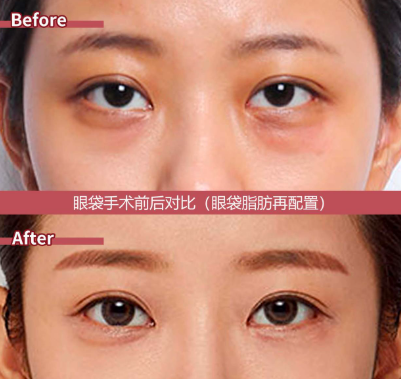 北京马力眼袋三件套效果怎么样？有人找马力做过祛眼袋吗？