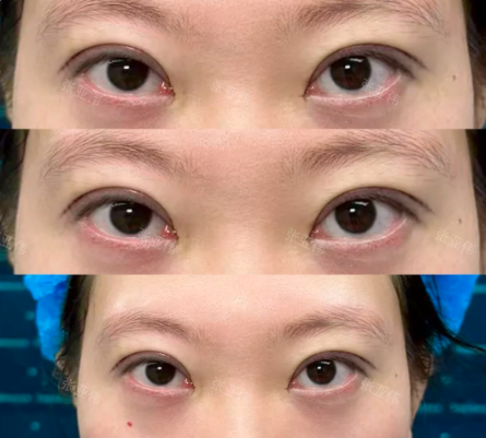北京张亚伟双眼皮效果怎么样？张亚伟割双眼皮有没有差评？