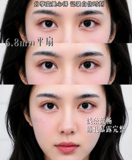 北京郭锋双眼皮技术怎么样?割双眼皮的郭锋在哪个医院坐诊?