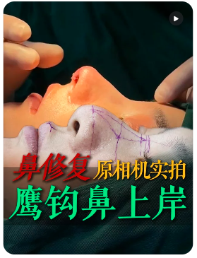 厦门鼻修复钟德成医生技术怎么样?有没有找钟德成修过鼻子?