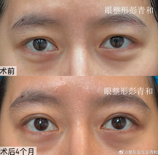 长沙割双眼皮医生邹俊峰和彭青和谁技术好？想自然效果怎么选择？