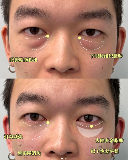 长沙谭骛远和方柏荣哪个医生做祛眼袋效果好？