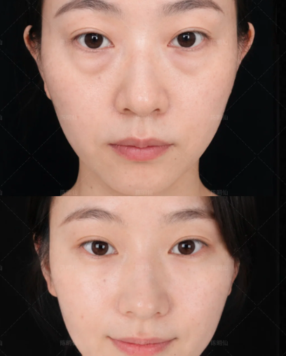 昆明去眼袋医生洪晓娅和陈明仙谁做祛眼袋技术好不复发？