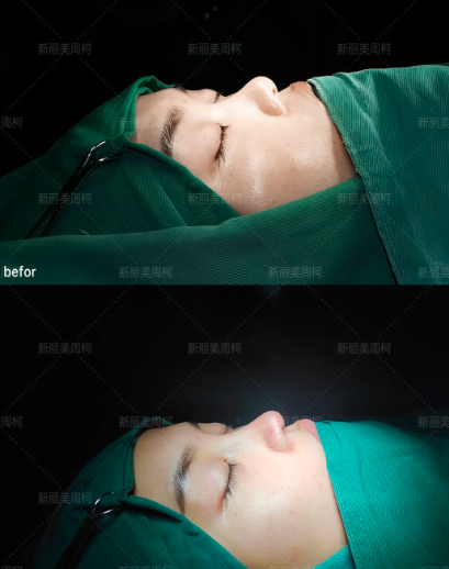成都隆鼻修复专家谁最好？隆鼻卿勇和周柯哪个医生做鼻修复好？