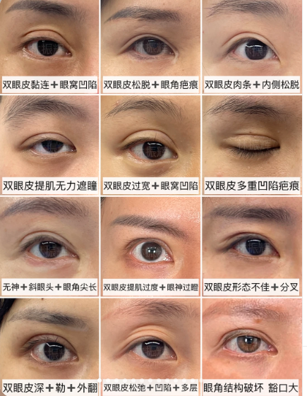 福州双眼皮修复医生林振辉和察鹏飞哪个眼修复效果好？
