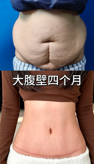成都做腹壁成形郑岩和罗通贵哪个医生技术好?