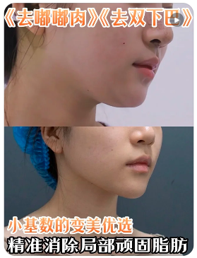 成都面部吸脂李鹏辉和邓萌哪个医生好?