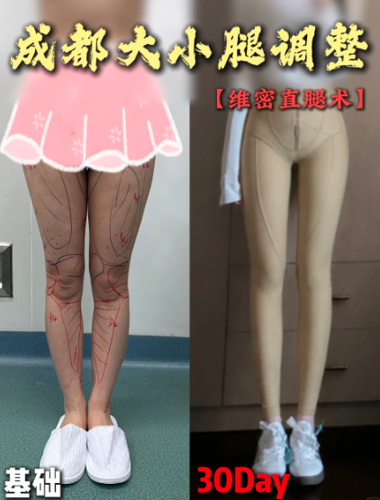 成都直腿矫正李烈和郑博晨哪个医生好?