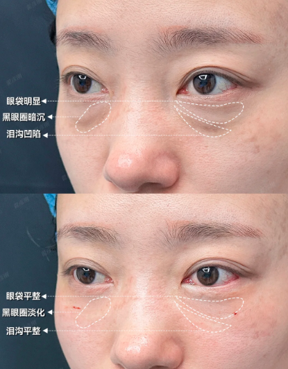 石家庄祛眼袋蔡鹏武和张玉辉哪个医生好?