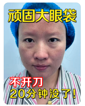 呼哈浩特祛眼袋梁永久和白虎哪个医生技术好？