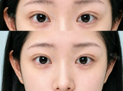 哈尔滨割双眼皮宋明亮和马媛哪个医生技术好？